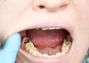 Are Cavities Genetic