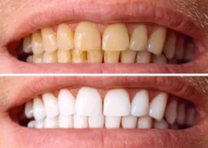 Before and after professional teeth whitening at a Chicago dental clinic