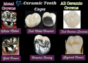 Ceramic Teeth Caps