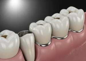 Close-up illustration of a traditional dental bridge filling a tooth gap