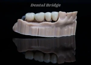 Dental Bridges