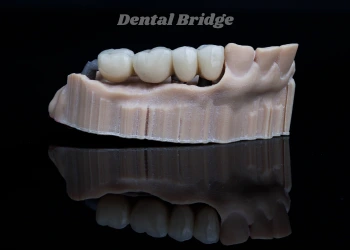 Dental Bridges