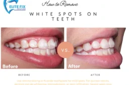How to Remove White Spots on Teeth: Causes, Treatments, and Prevention