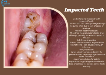Impacted Teeth