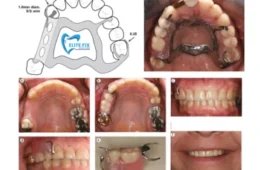 Partial Dentures for Back Teeth: Guide to Types, Care & Lifespan in Chicago