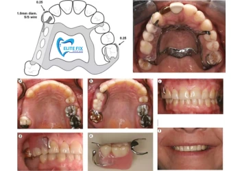 Partial Dentures for Back Teeth