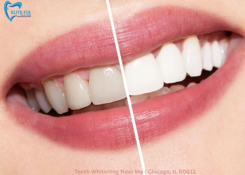 Teeth Whitening Near Me