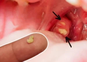Tonsil Stones