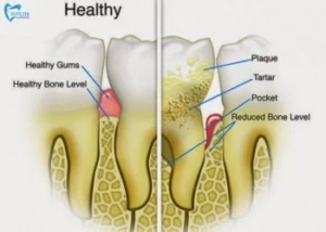 What Is Tartar on Teeth