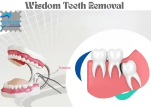 Wisdom Teeth Removal Cost