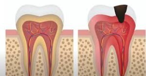 Why Does Root Canal Tooth Hurts with Pressure? Best Solution