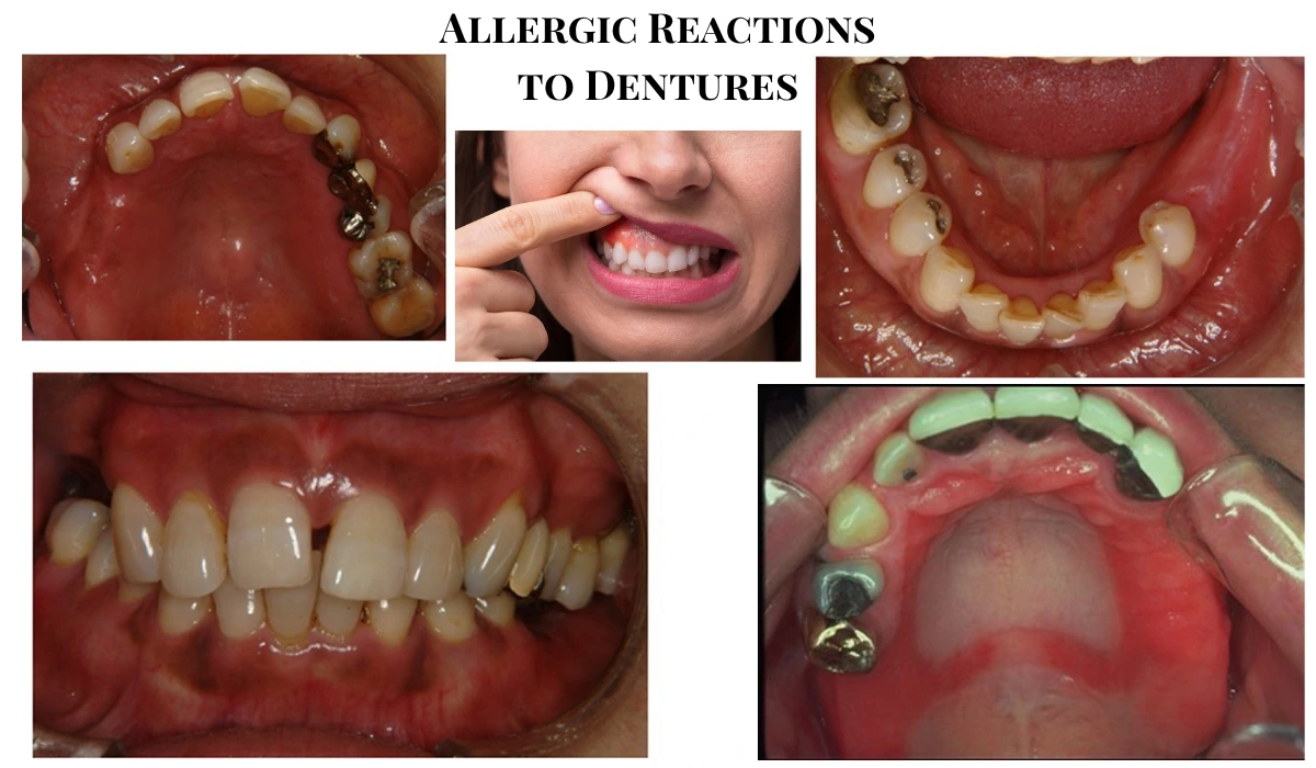Allergic Reactions to Dentures
