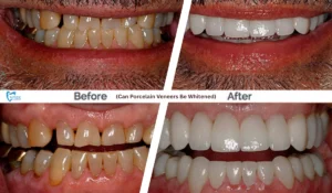 Can Porcelain Veneers Be Whitened