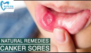 Canker Sore Treatment