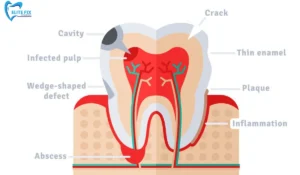 Common Causes of Toothache