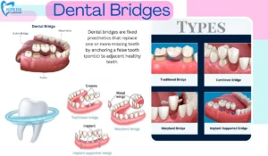 Dental Bridges