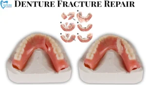Denture Fracture Repair