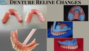 Denture Reline Changes