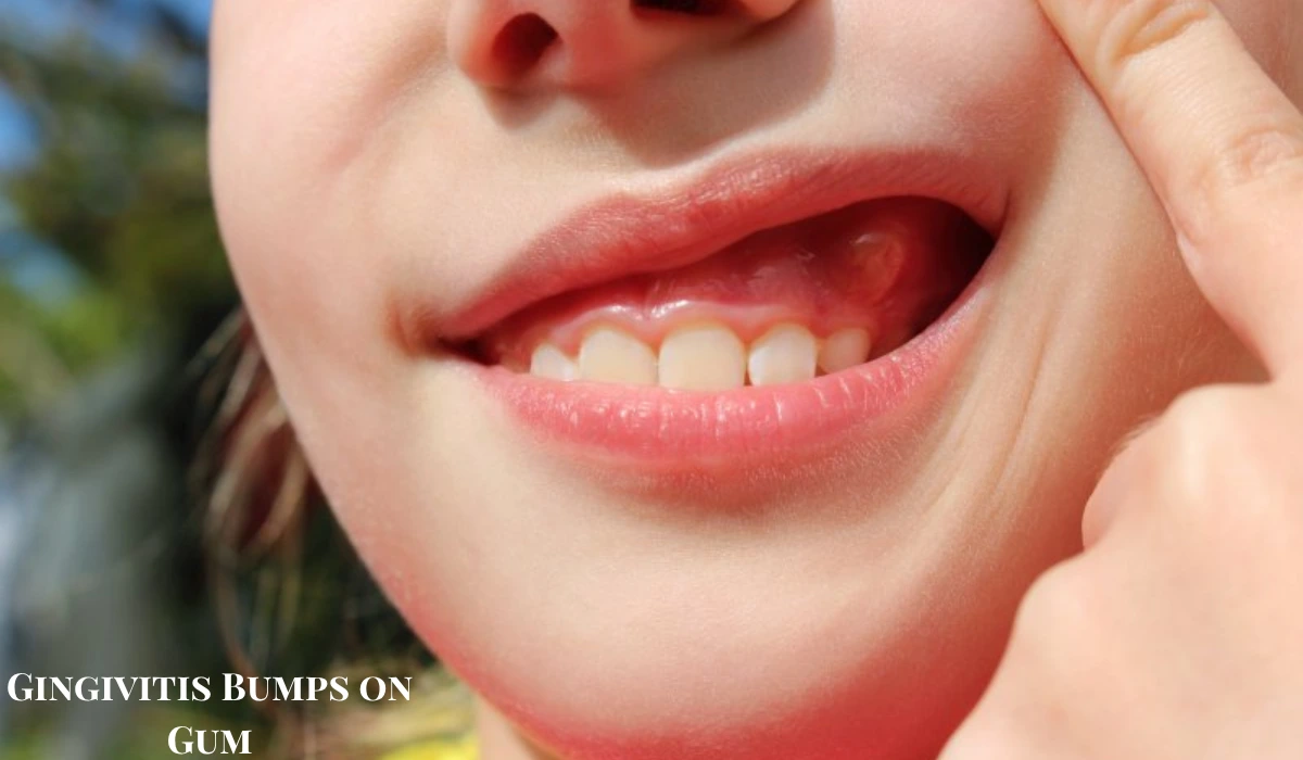 Gingivitis Bumps on Gum