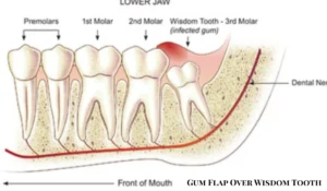 Gum Flap Over Wisdom Tooth