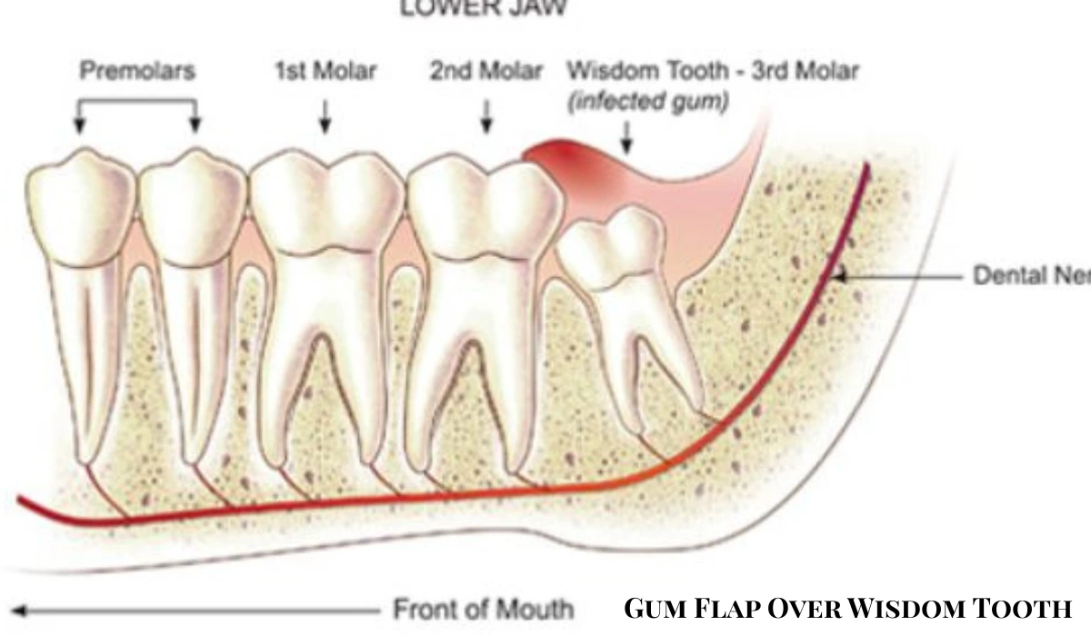 Gum Flap Over Wisdom Tooth