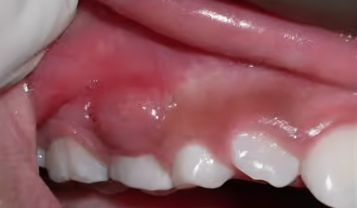 Gum Swelling After Root Canal