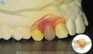 How Does a Single Tooth Denture Stay in