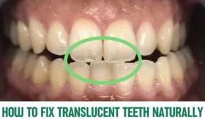 How to Fix Translucent Teeth Naturally