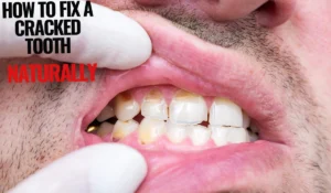 How to Fix a Cracked Tooth Naturally