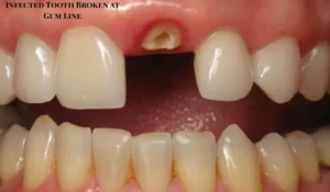 Infected Tooth Broken at Gum Line