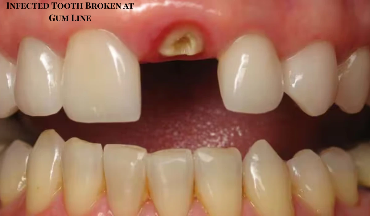 Infected Tooth Broken at Gum Line