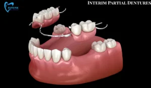 Interim Partial Dentures