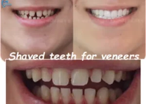 Veneer Teeth Shaving