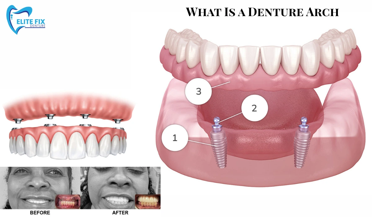 What Is a Denture Arch