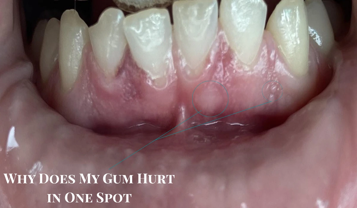 Why Does My Gum Hurt in One Spot