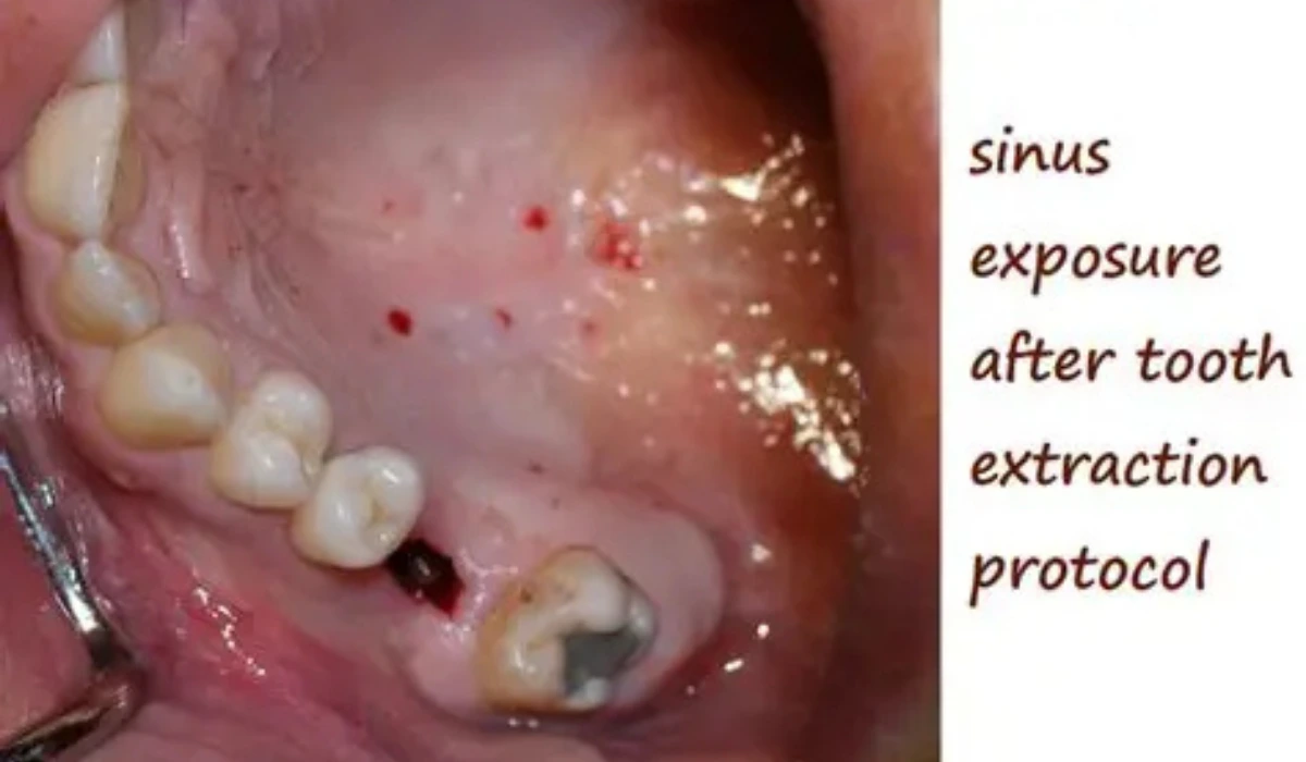 Sinus Perforation After Tooth Extraction