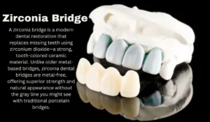 Zirconia Bridge