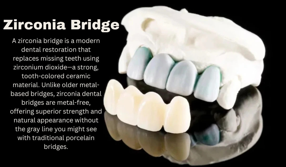 Zirconia Bridge