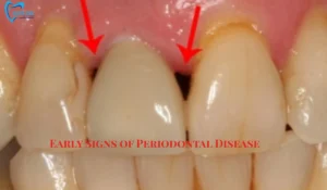 Early Periodontal