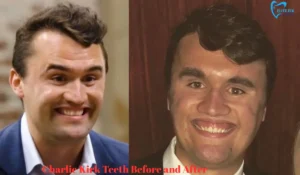 Charlie Kirk Teeth Before and After