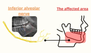 Symptoms of Nerve Damage After Wisdom Teeth Removal