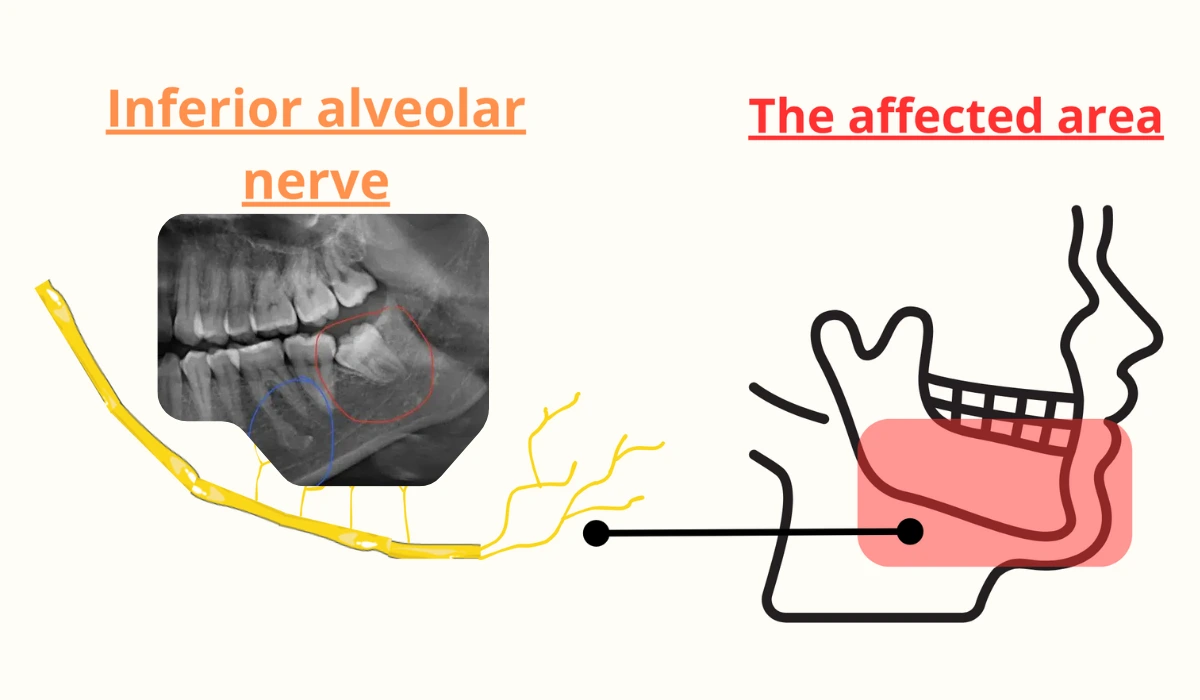 Symptoms of Nerve Damage After Wisdom Teeth Removal