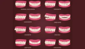 ideal perfect bite teeth alignment