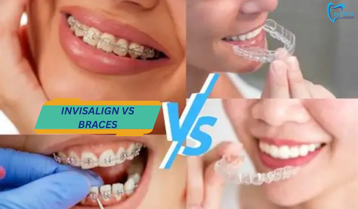 Invisalign vs Braces