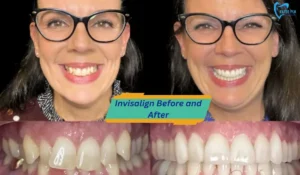 Invisalign Before And After