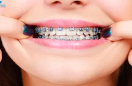 Braces for Adults (2026): Cost, Insurance, Types & Real Results