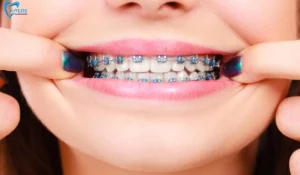 BRACES FOR ADULTS