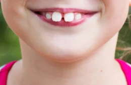 Buck Teeth (Overjet): Causes, Risks, Braces, Aligners & Cost Guide 2026