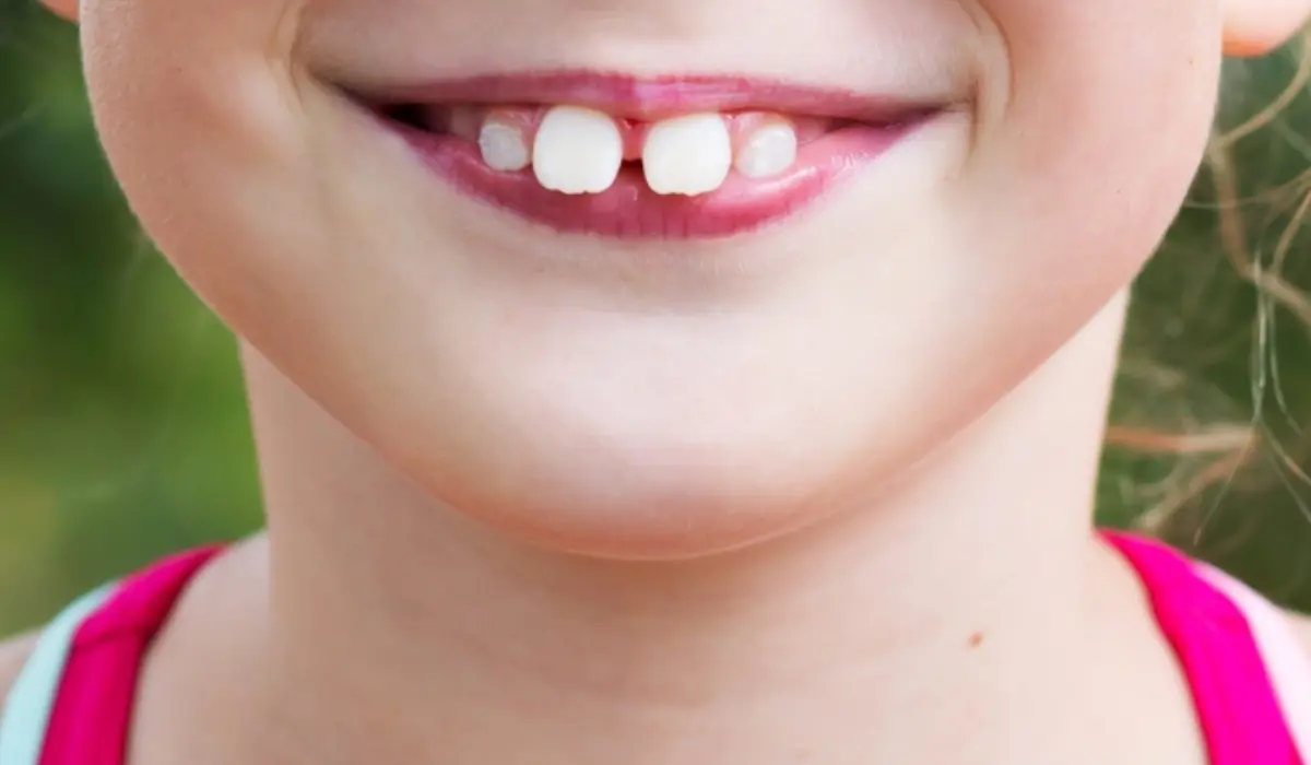 Buck Teeth