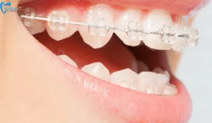 Ceramic Braces for Adults